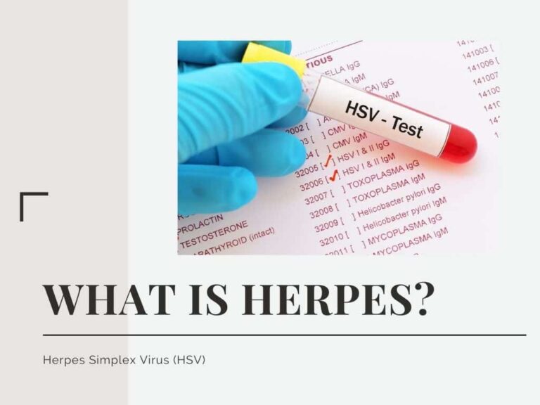 How Long Can You Have Herpes Without Knowing